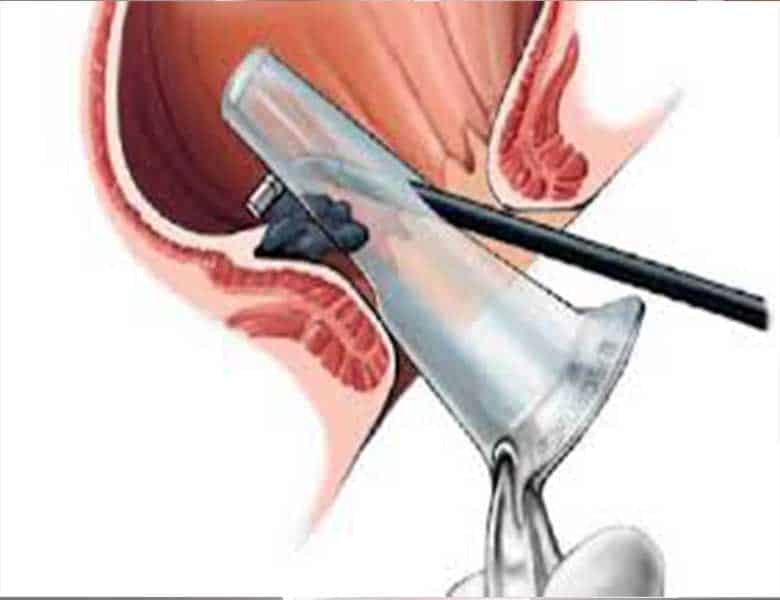 Img-Anoscopia